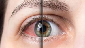 तुम्ही ज्याला मानत आहात साधी ऍलर्जी, ती असू शकते Urban Eye Syndrome, प्रदूषणामुळे डोळे का पडत आहेत आजारी