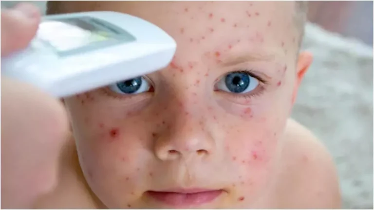 measles-cases-increased-by-88-percent-in-the-world-in-one-year-shocking-reason-revealed