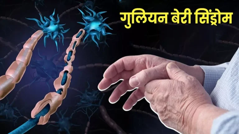 guillain-barre-syndrome-gbs-cases-rises-to-180-in-pune-mumbai-records-first-case