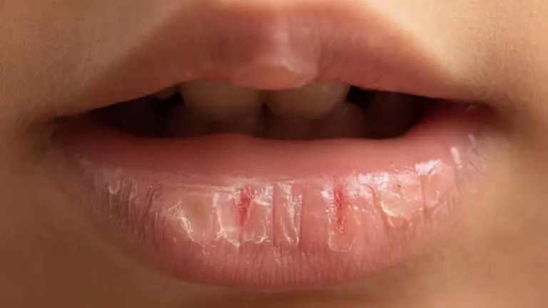 lip-care-get-back-the-beauty-of-your-lips-with-these-kitchen-items