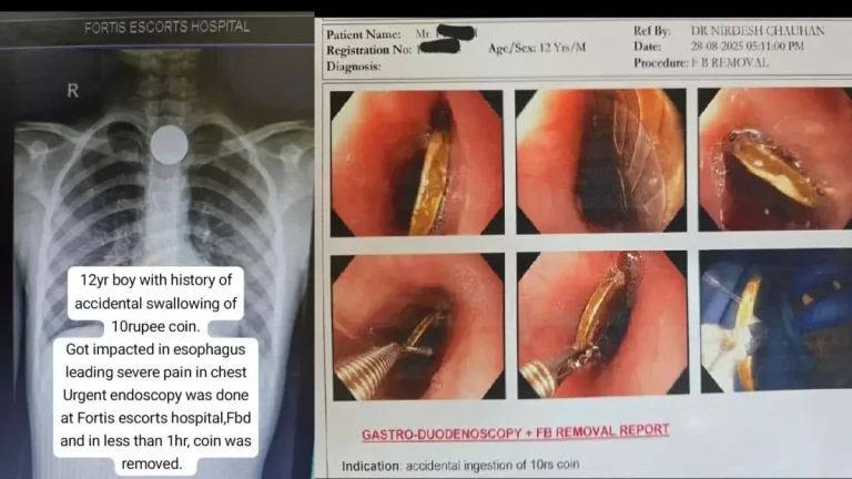 doctors-at-fortis-escorts-faridabad-successfully-removed-a-10-rupees-coin-stuck-in-food-pipe-of-a-12-year-old-boy