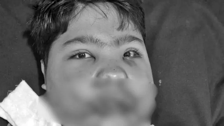 jabalpur-fridge-blast-108-bones-cracked-of-14-year-kid-surgery-successful
