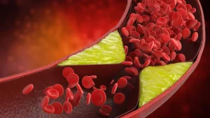 High Cholesterol: बाहेरून आहात फिट, पण आतून शिरा होत आहेत का ब्लॉक? उच्च कोलेस्ट्रॉलची 5 लपलेली लक्षणे