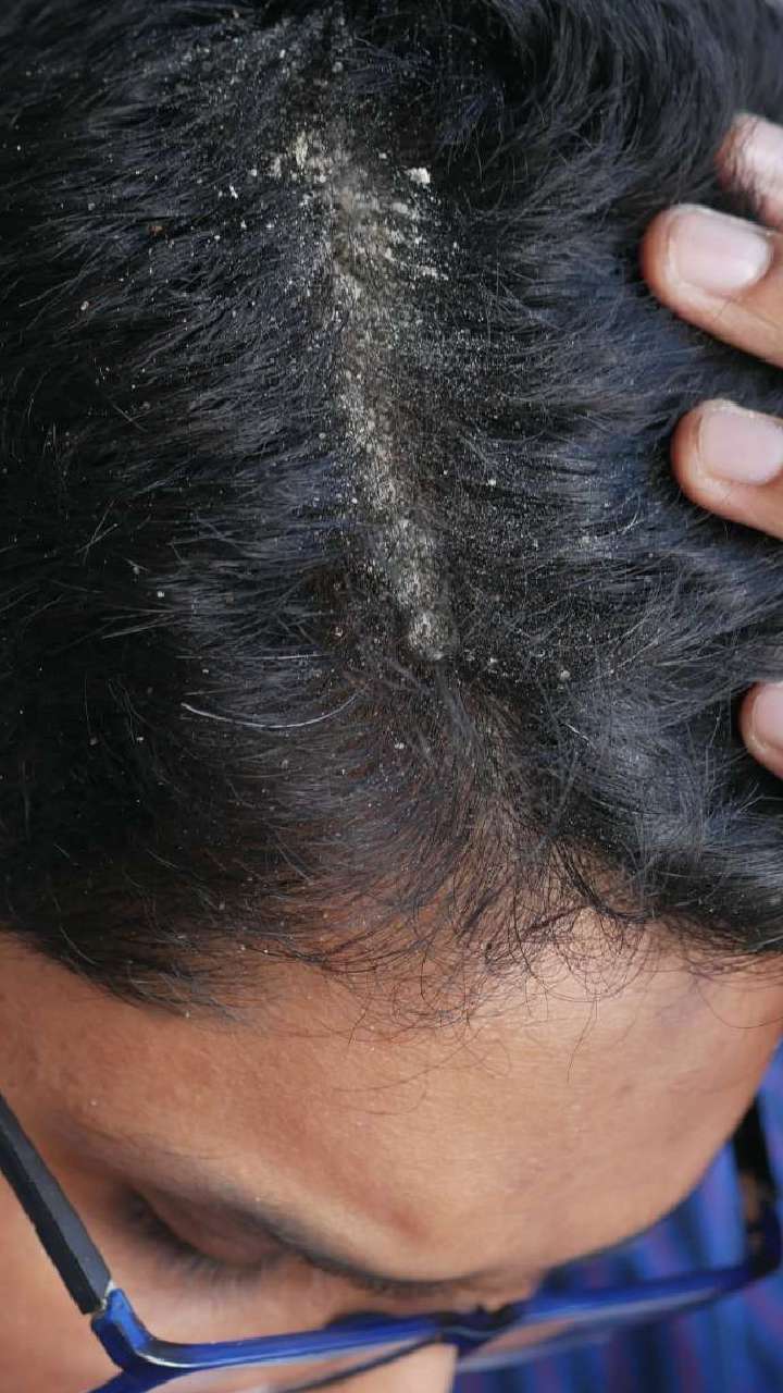 कोंडा दूर करण्यासाठी केसांना लावा हे तेल