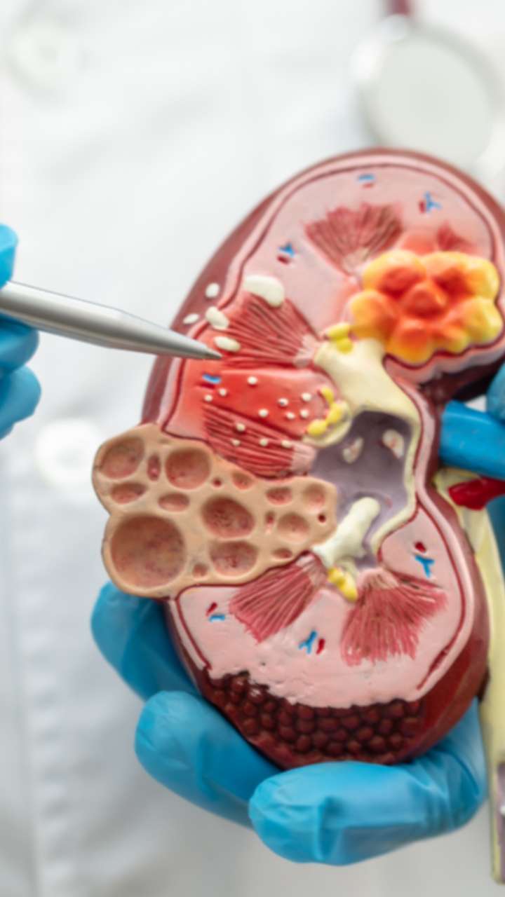 World Kidney Day 2025: या उपायांनी टाळता येतो किडनी स्टोन