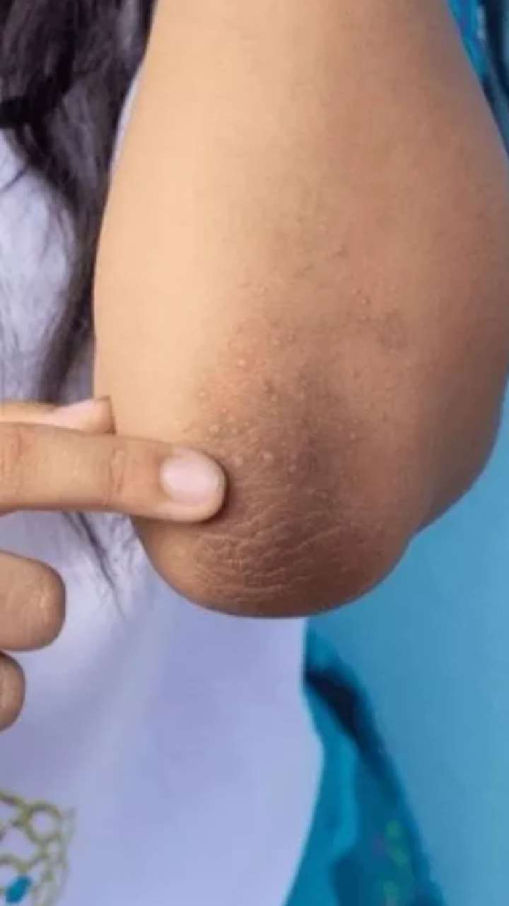 या घरगुती उपायांनी चमकवा काळे कोपर आणि गुडघे